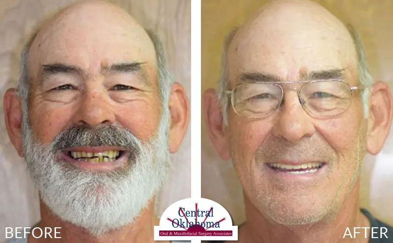 All-on-4 before and after | Oral Surgery Oklahoma City | Dr. Richard Miller | Central Oklahoma Oral & Maxillofacial Surgery Associates