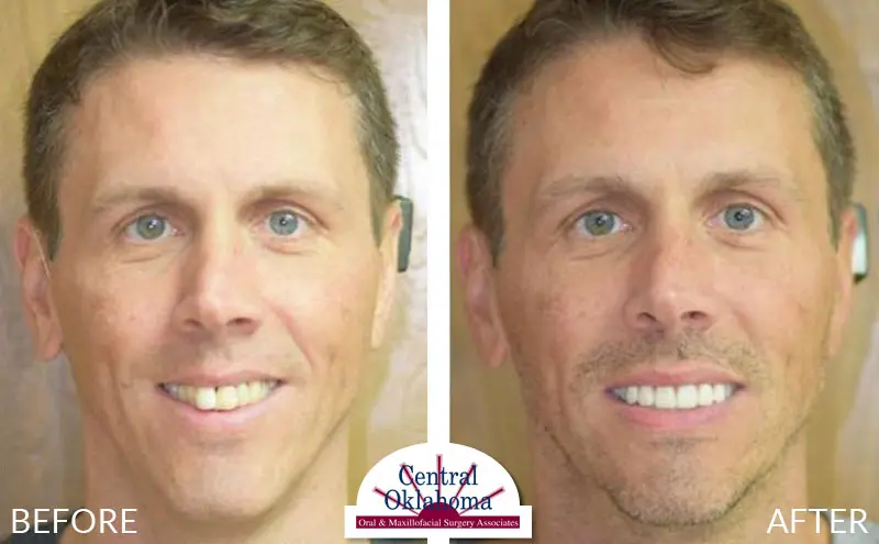 All-on-4 before and after | Oral Surgery OKC | Dr. Richard Miller | Central Oklahoma Oral & Maxillofacial Surgery Associates