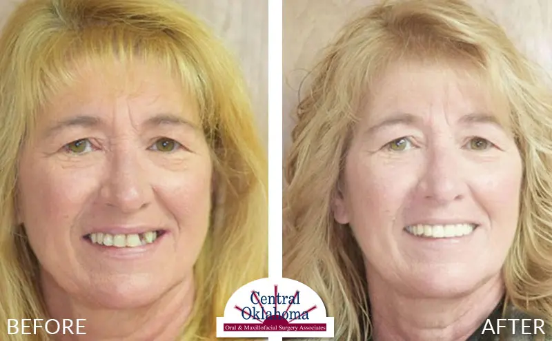 All-on-4 before and after | Oral Surgery Stillwater | Dr. Richard Miller | Central Oklahoma Oral & Maxillofacial Surgery Associates