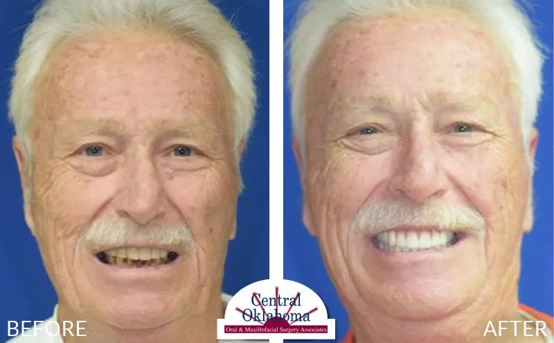 All-on-4 before and after | Oral Surgery Stillwater | Dr. Richard Miller | Central Oklahoma Oral & Maxillofacial Surgery Associates