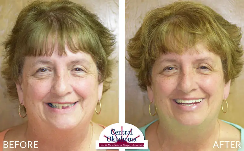 All-on-4 before and after | Oral Surgery Stillwater | Dr. Richard Miller | Central Oklahoma Oral & Maxillofacial Surgery Associates