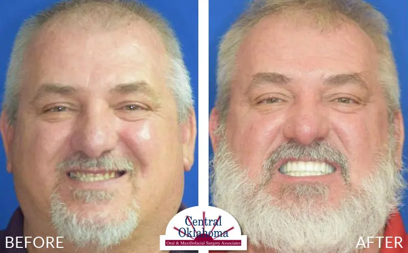 All-on-4 before and after | Oral Surgery Stillwater | Dr. Richard Miller | Central Oklahoma Oral & Maxillofacial Surgery Associates