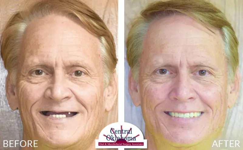 All-on-4 before and after | Oral Surgery Tulsa | Dr. Richard Miller | Central Oklahoma Oral & Maxillofacial Surgery Associates