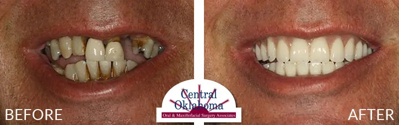 All-on-4 before and after | Oral Surgery Tulsa | Dr. Richard Miller | Central Oklahoma Oral & Maxillofacial Surgery Associates