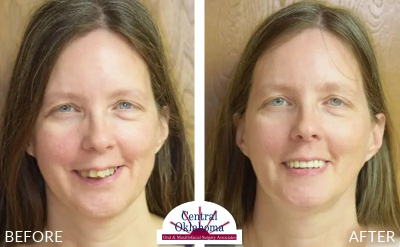 All-on-4 before and after | Oral Surgery Tulsa | Dr. Richard Miller | Central Oklahoma Oral & Maxillofacial Surgery Associates