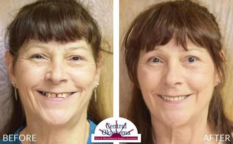 All-on-4 before and after | Oral Surgery Oklahoma City | Dr. Richard Miller | Central Oklahoma Oral & Maxillofacial Surgery Associates