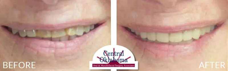 All-on-4 before and after | Oral Surgery OKC | Dr. Richard Miller | Central Oklahoma Oral & Maxillofacial Surgery Associates