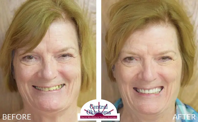 All-on-4 before and after | Oral Surgery OKC | Dr. Richard Miller | Central Oklahoma Oral & Maxillofacial Surgery Associates