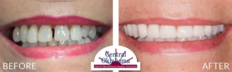 All-on-4 before and after | Oral Surgery Oklahoma City | Dr. Richard Miller | Central Oklahoma Oral & Maxillofacial Surgery Associates