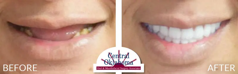 All-on-4 before and after | Oral Surgery Stillwater | Dr. Richard Miller | Central Oklahoma Oral & Maxillofacial Surgery Associates