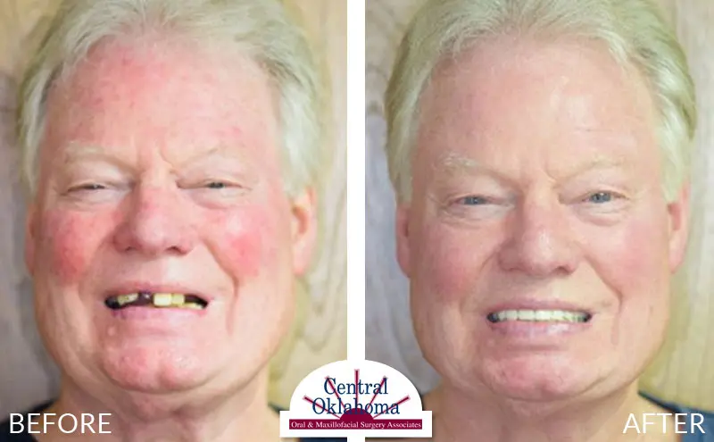 All-on-4 before and after | Oral Surgery Stillwater | Dr. Richard Miller | Central Oklahoma Oral & Maxillofacial Surgery Associates