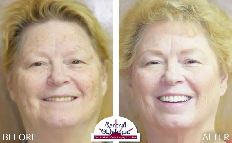 All-on-4 before and after | Oral Surgery Tulsa | Dr. Richard Miller | Central Oklahoma Oral & Maxillofacial Surgery Associates