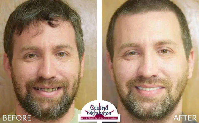 All-on-4 before and after | Oral Surgery Tulsa | Dr. Richard Miller | Central Oklahoma Oral & Maxillofacial Surgery Associates