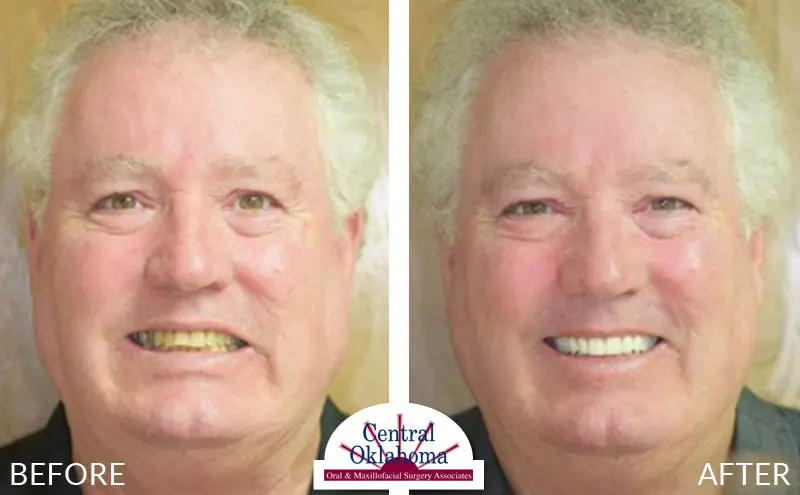 dental implants before and after | Oral Surgery Oklahoma City | Dr. Richard Miller | Central Oklahoma Oral & Maxillofacial Surgery Associates