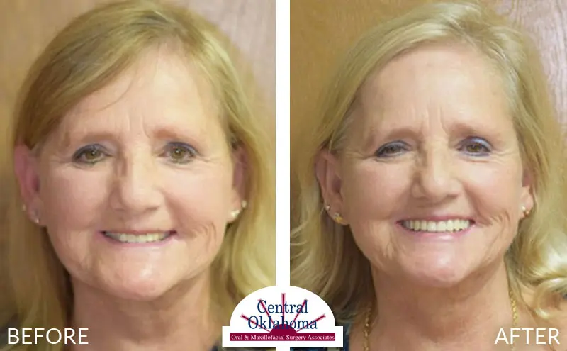 dental implants before and after | Oral Surgery Oklahoma City | Dr. Richard Miller | Central Oklahoma Oral & Maxillofacial Surgery Associates