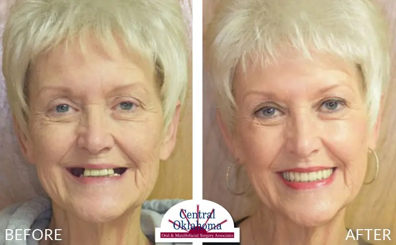 dental implants before and after | Oral Surgery Stillwater | Dr. Richard Miller | Central Oklahoma Oral & Maxillofacial Surgery Associates