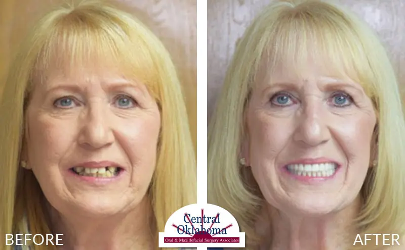dental implants before and after | Oral Surgery Stillwater | Dr. Richard Miller | Central Oklahoma Oral & Maxillofacial Surgery Associates