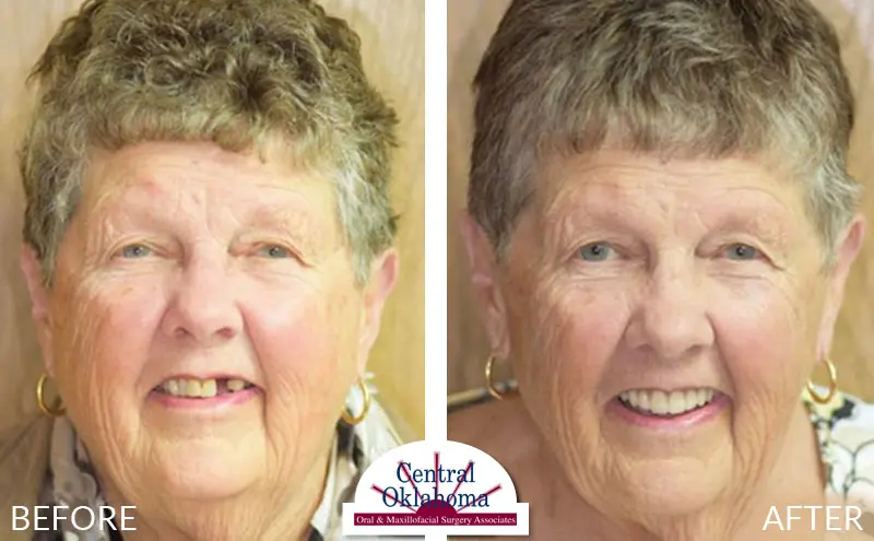 dental implants before and after | Oral Surgery Stillwater | Dr. Richard Miller | Central Oklahoma Oral & Maxillofacial Surgery Associates