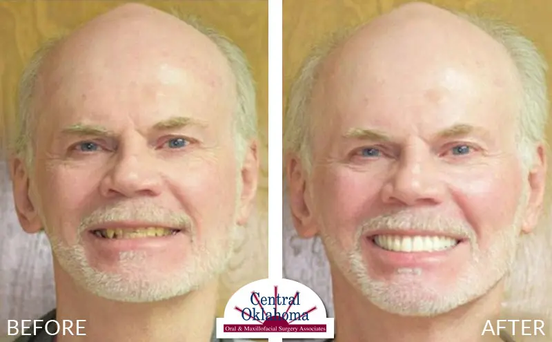 dental implants before and after | Oral Surgery Tulsa | Dr. Richard Miller | Central Oklahoma Oral & Maxillofacial Surgery Associates