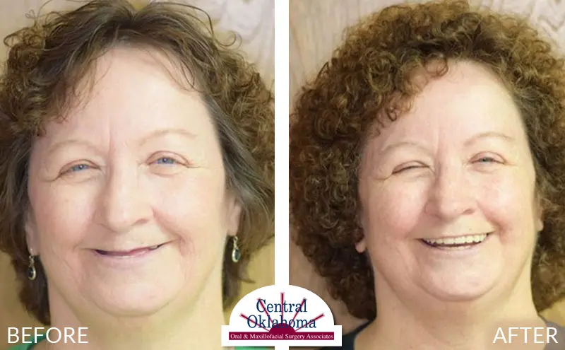 dental implants before and after | Oral Surgery Tulsa | Dr. Richard Miller | Central Oklahoma Oral & Maxillofacial Surgery Associates