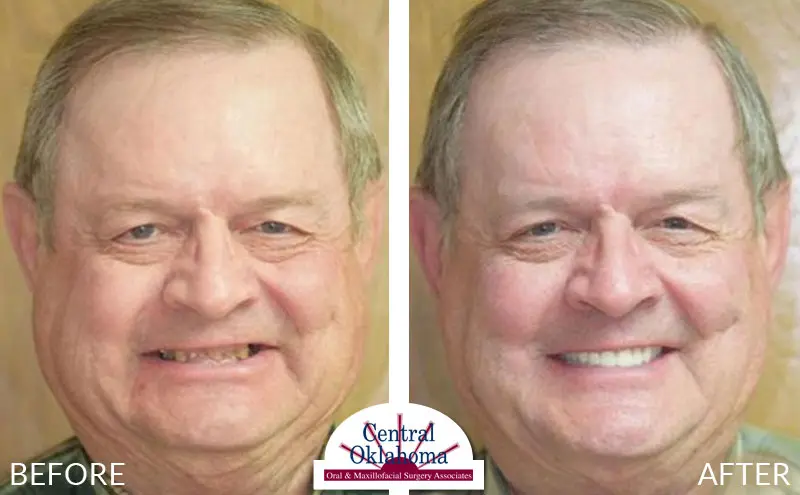 dental implants before and after | Oral Surgery Tulsa | Dr. Richard Miller | Central Oklahoma Oral & Maxillofacial Surgery Associates