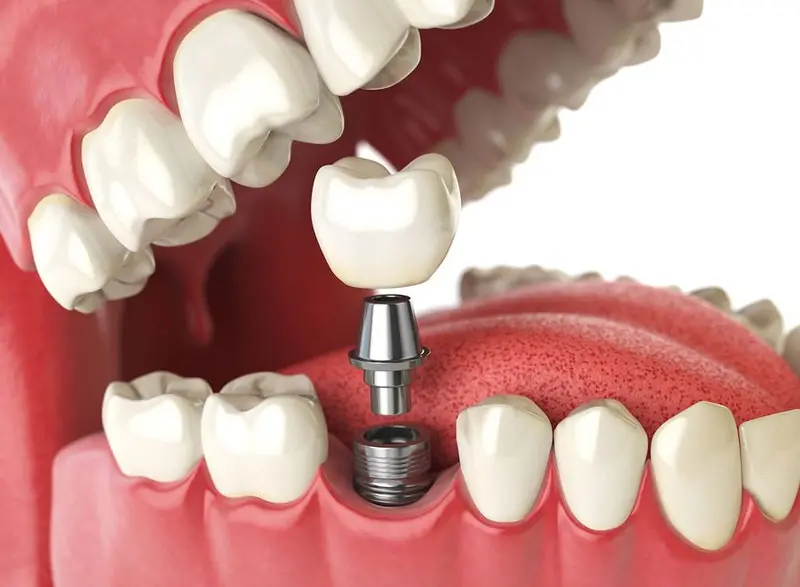 dental-implants-tulsa-oklahoma Dental implants | Oral Surgery Oklahoma | Dr. Richard Miller | Central Oklahoma Oral & Maxillofacial Surgery Associates