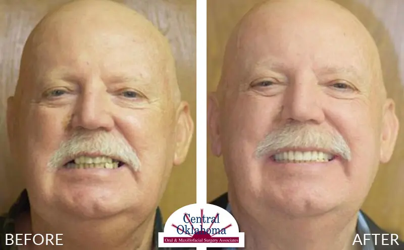 Oral Surgery before and after | Oral Surgery Oklahoma City | Dr. Richard Miller | Central Oklahoma Oral & Maxillofacial Surgery Associates