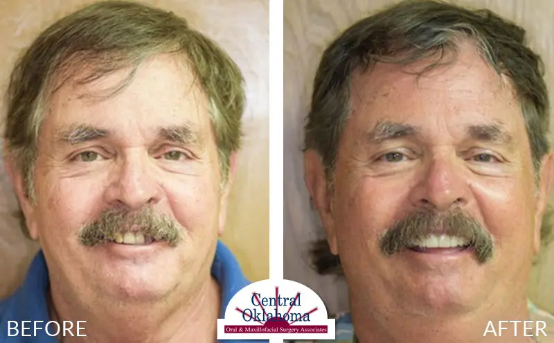Oral Surgery before and after | Oral Surgery Oklahoma City | Dr. Richard Miller | Central Oklahoma Oral & Maxillofacial Surgery Associates