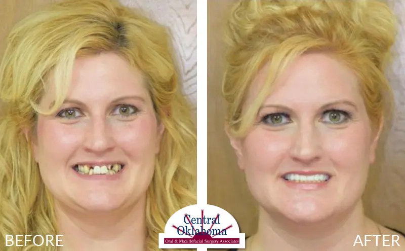 Oral Surgery before and after | Oral Surgery OKC | Dr. Richard Miller | Central Oklahoma Oral & Maxillofacial Surgery Associates