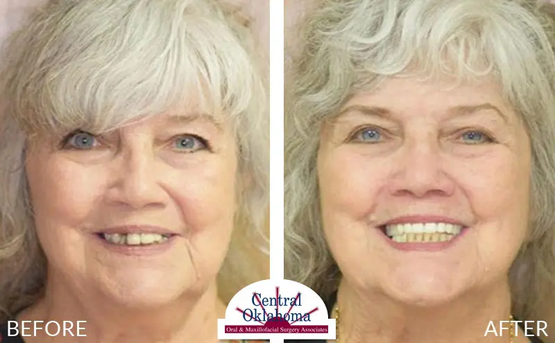 Oral Surgery before and after | Oral Surgery Stillwater | Dr. Richard Miller | Central Oklahoma Oral & Maxillofacial Surgery Associates