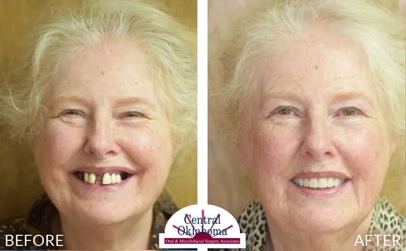 Oral Surgery before and after | Oral Surgery Stillwater | Dr. Richard Miller | Central Oklahoma Oral & Maxillofacial Surgery Associates