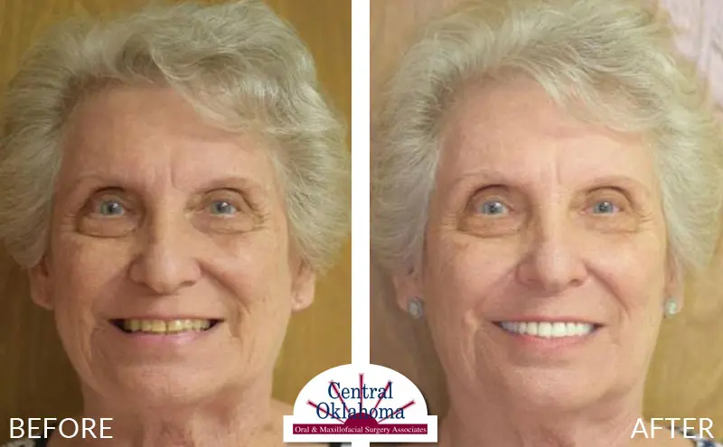 Oral Surgery before and after | Oral Surgery Tulsa | Dr. Richard Miller | Central Oklahoma Oral & Maxillofacial Surgery Associates