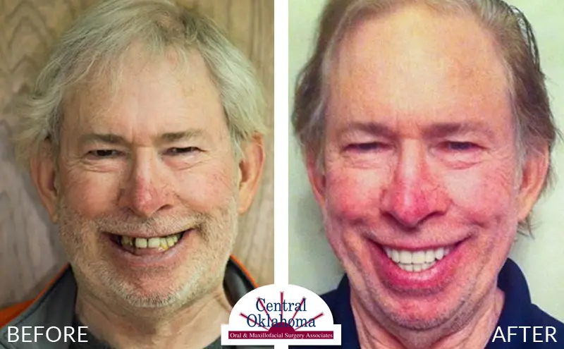 Oral Surgery before and after | Oral Surgery Tulsa | Dr. Richard Miller | Central Oklahoma Oral & Maxillofacial Surgery Associates