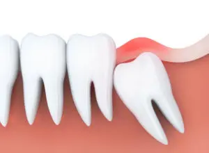 Wisdom teeth extraction | Oral Surgery Oklahoma | Dr. Richard Miller | Central Oklahoma Oral & Maxillofacial Surgery Associates