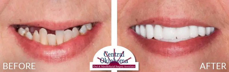 All on 4 implants | Oral Surgery Tulsa | Dr. Richard Miller | Central Oklahoma Oral & Maxillofacial Surgery Associates