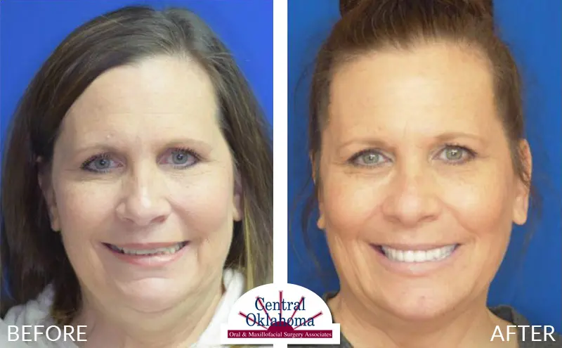 All-on-4 before and after | Oral Surgery Stillwater | Dr. Richard Miller | Central Oklahoma Oral & Maxillofacial Surgery Associates