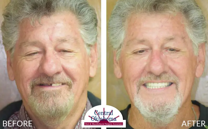 Oral Surgery Before and After #3