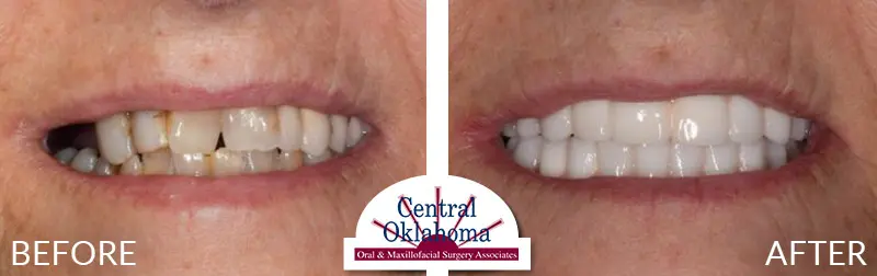 All on 4 implants | Oral Surgery Tulsa | Dr. Richard Miller | Central Oklahoma Oral & Maxillofacial Surgery Associates