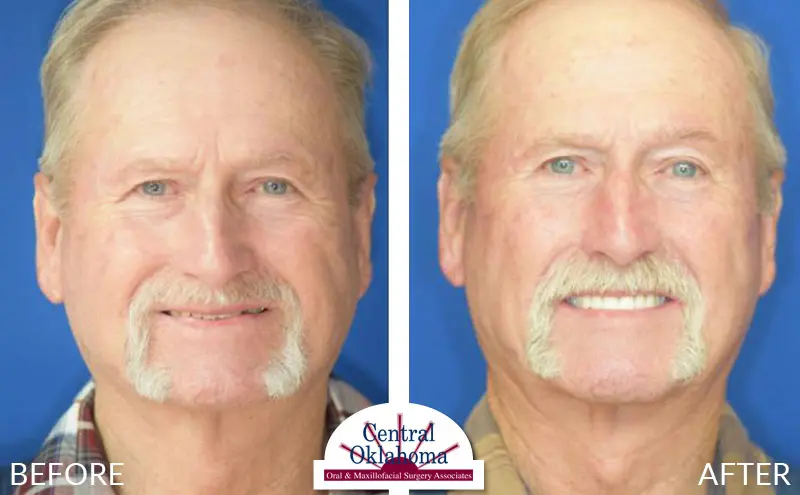 All-on-4 Implants before and after