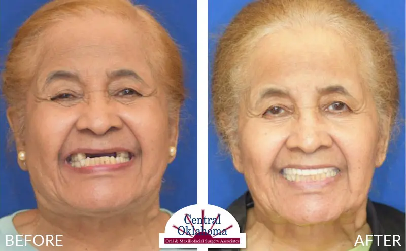 All-on-4 Before and After #4