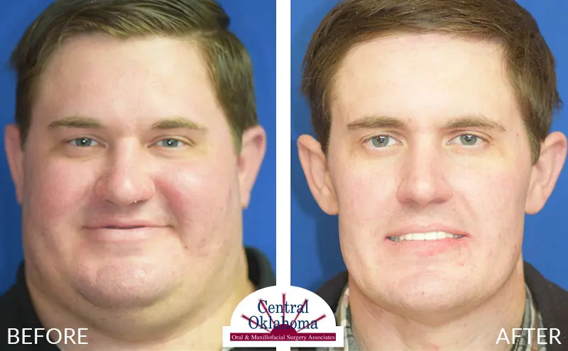 dental implants before and after | Oral Surgery Tulsa | Dr. Richard Miller | Central Oklahoma Oral & Maxillofacial Surgery Associates