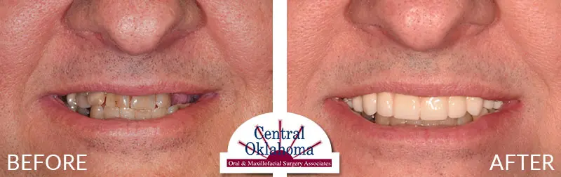 dental implants before and after | Oral Surgery Tulsa | Dr. Richard Miller | Central Oklahoma Oral & Maxillofacial Surgery Associates