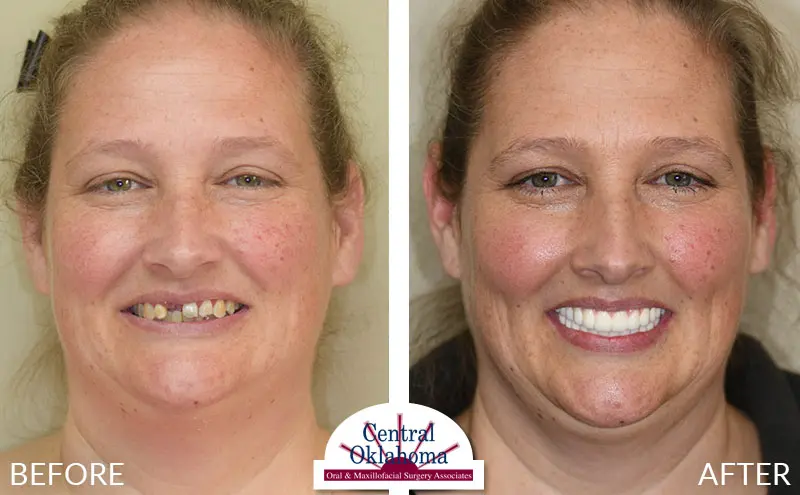 dental implants before and after | Oral Surgery Tulsa | Dr. Richard Miller | Central Oklahoma Oral & Maxillofacial Surgery Associates