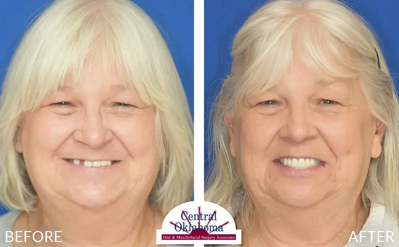 dental implants before and after | Oral Surgery Tulsa | Dr. Richard Miller | Central Oklahoma Oral & Maxillofacial Surgery Associates
