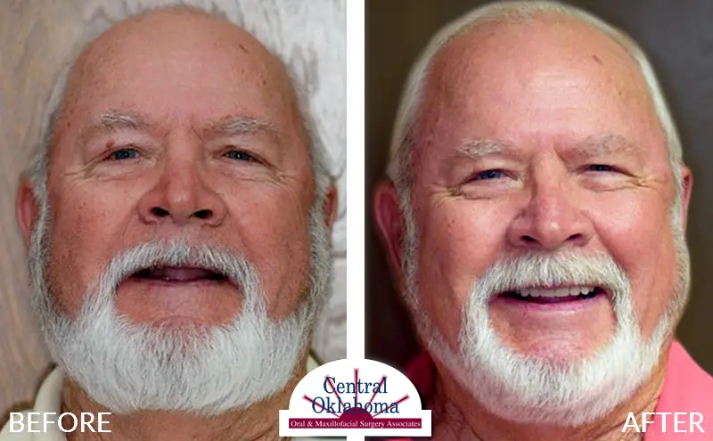 all-on-4-implants-stillwater-oklahoma-EDIT