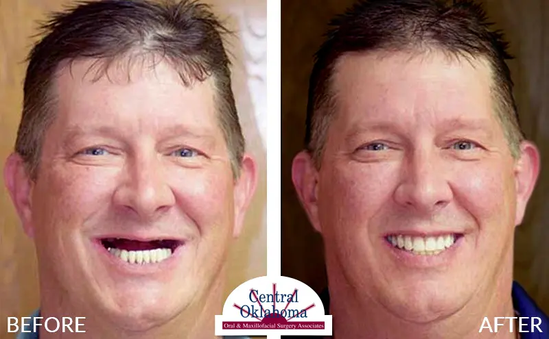 all-on-4-implants-tulsa-oklahoma-EDIT