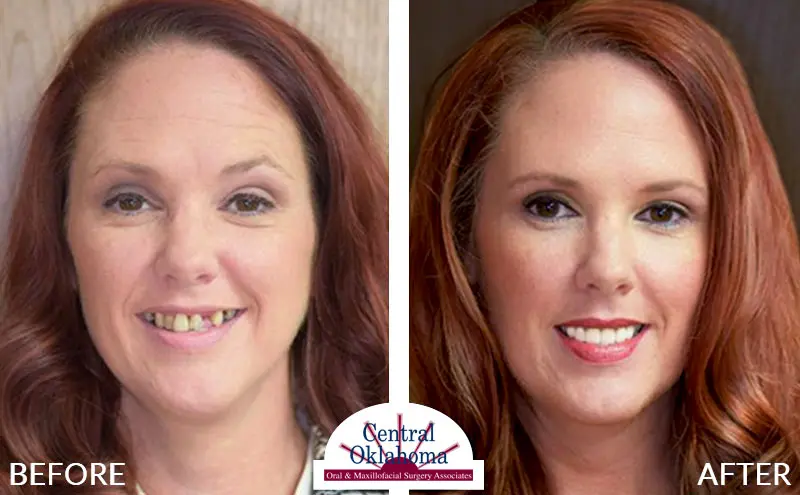 dental-implants-stillwater-ok-EDIT