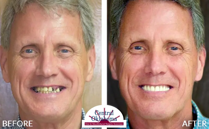 dental-implants-tulsa-ok-EDIT