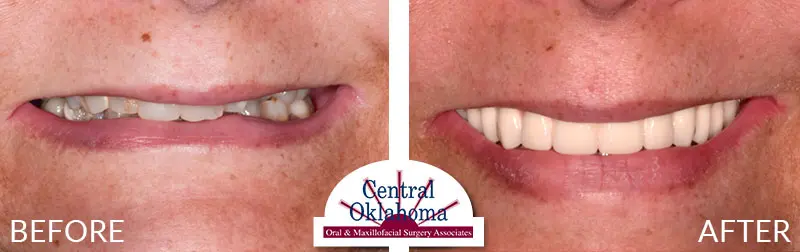 dental implants before and after | Oral Surgery Tulsa | Dr. Richard Miller | Central Oklahoma Oral & Maxillofacial Surgery Associates