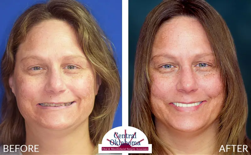 dental implants before and after | Oral Surgery Tulsa | Dr. Richard Miller | Central Oklahoma Oral & Maxillofacial Surgery Associates